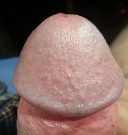 Photo of the enlarged penis on the head