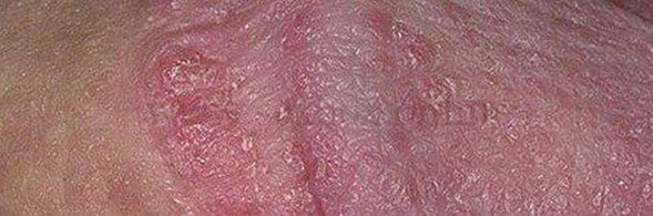 Dry skin and ulcers of the penis head after using baking soda