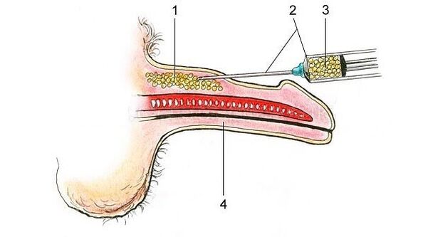 hyaluronic acid injection for penile thickening
